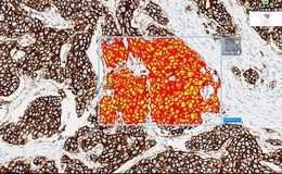 Skin melanoma showing digital measurements of Breslow’s Depth and distance to margins.