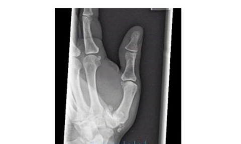 thumb arthritis xray